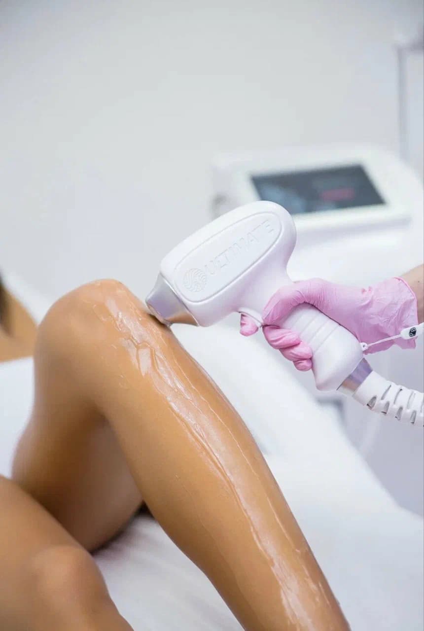 Процедура лазерной эпиляции - лазерное устройство ULTIMATE применяется к ноге клиента